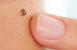 AI machine diagnoses skin cancer, could be used in smartphones