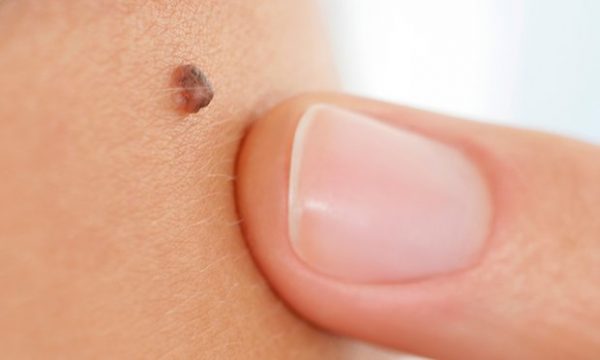 AI machine diagnoses skin cancer, could be used in smartphones