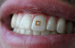 tooth wearable tracks your diet