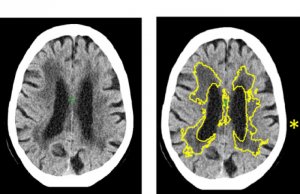 dementia diagnosis machine learning