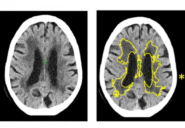 dementia diagnosis machine learning